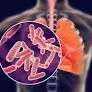 bệnh lao phổi là gì từ hongngochospital.vn