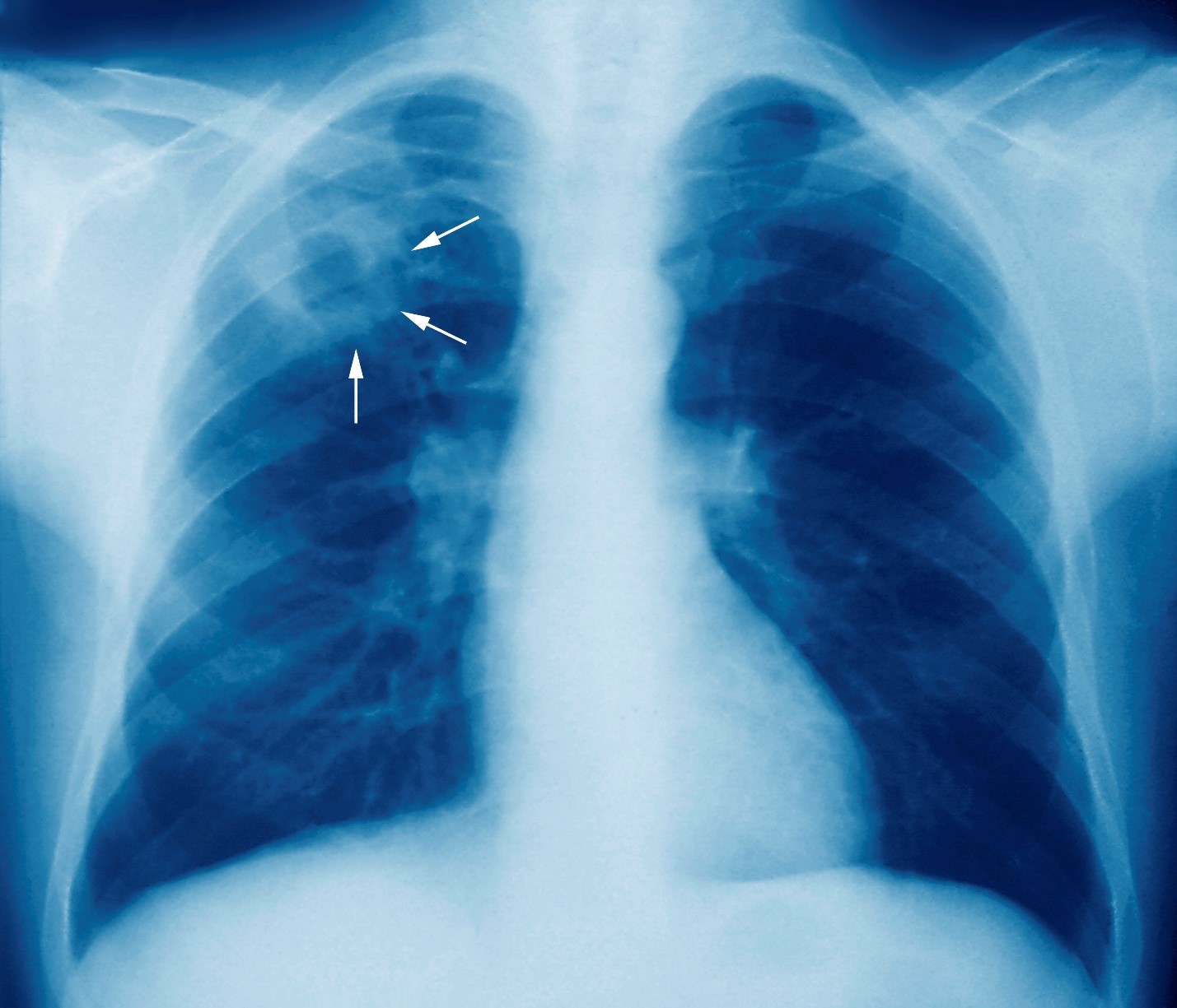 https://www.msdmanuals.com/-/media/manual/professional/images/m/2/7/m2700245-tuberculosis-chest-x-ray-science-photo-library-high_vi.jpg?thn=0&sc_lang=vi